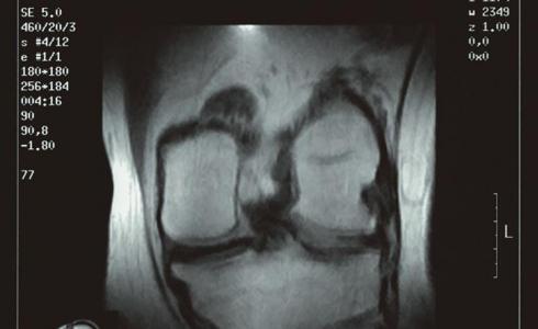 L'artrosis és una de la patologies més prevalents en la dona menopáusica